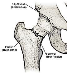 hip fracture alkaline water may help prevent hip fractures like this